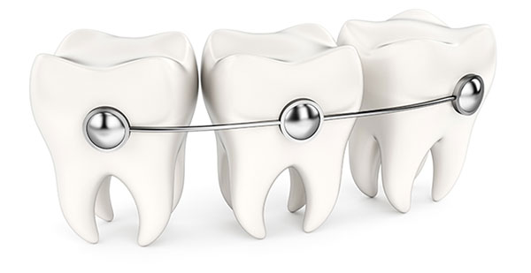 Metal Braces in El Segundo CA